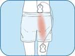 Sciatic