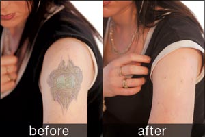 Rio Skin Camouflage before and after