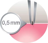 Close grip technology 