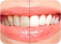 See noticeably whiter teeth in just one week.