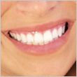 Whitening