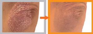 Clinical result after 6 weeks use of Dermalex Repair Psoriasis.